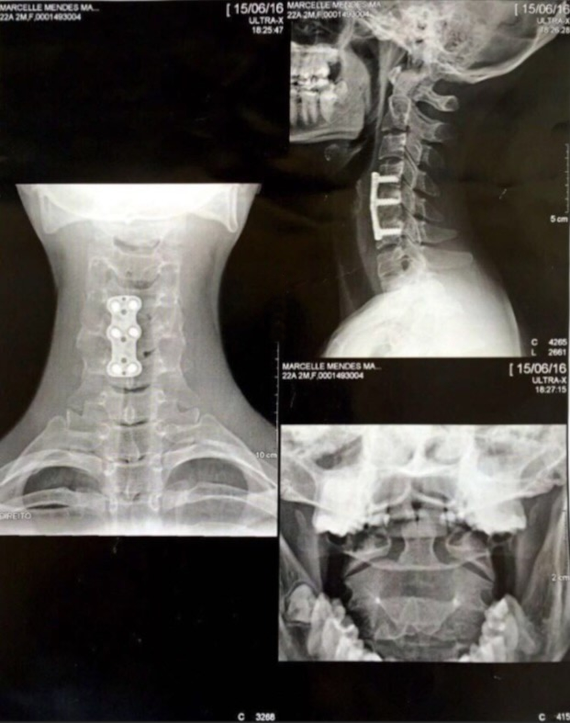 X-ray images showed she had broken one vertebra and dislocated two others