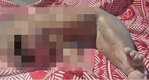 A baby in Tanzania was born with its lower body fused together like a 'mermaid' in an ultra rare case