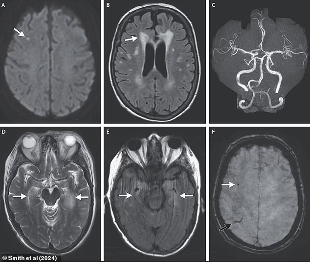 The above brain scans are suggestive of a stroke, brain tissue damage and narrowing of the brain's vessels