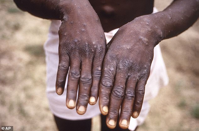 An image from 1997 shows symptoms of mpox on a sufferer in DRC, formerly Zaire