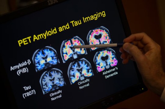 A picture of PET scan results