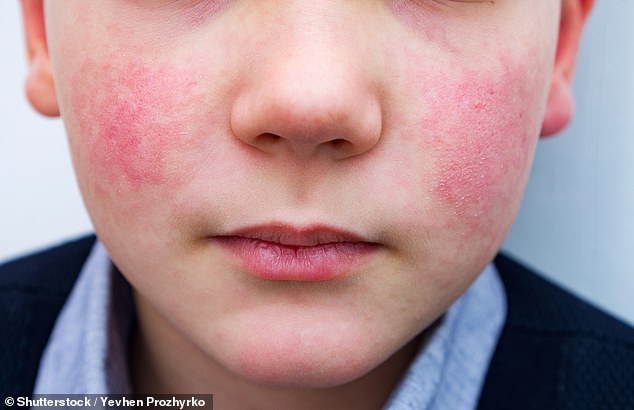 Parvovirus B19 causes a hallmark 'slapped cheek' rash in children. Once the rash occurs, patients are no longer contagious