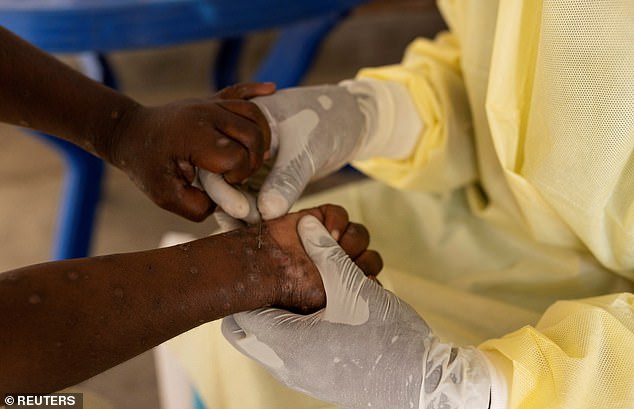 Christian Musema, a laboratory nurse, takes a sample from a child declared a suspected case of Mpox at the treatment centre in Munigi, Democratic Republic of the Congo