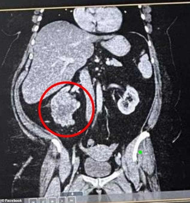 Sabrena Jones, from Oklahoma, was hospitalized for what she thought was a spider bite. But doctors then diagnosed her with stage three kidney cancer (her CT scan reveals the cancer as the large lump below the liver)