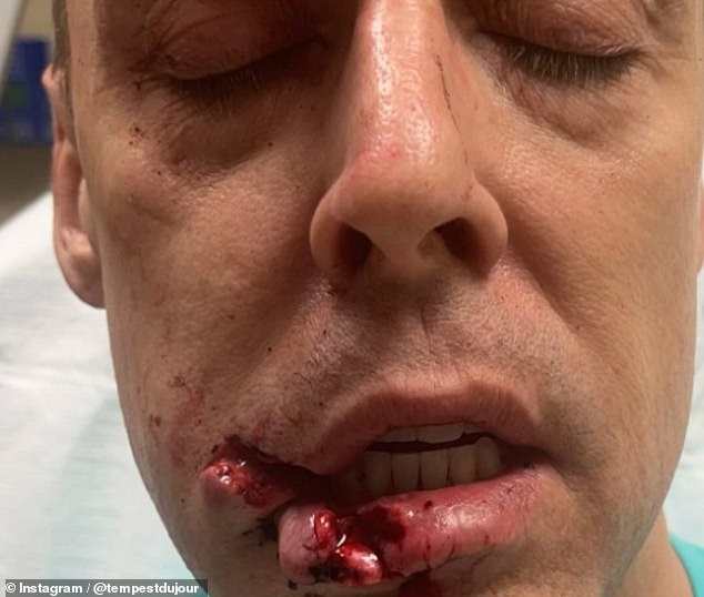 Shock photos shared to the social media platform also show the season 7 contestant's bleeding cut lip and stitches