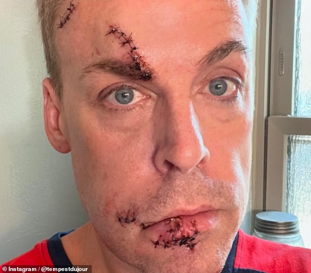 The 57-year-old told her 163,000 Instagram followers: 'About 3am Sunday morning I got out of bed and fainted, hitting the corner of my dresser. Five hours later I was stitched up, bottom lip reattached. Ugh'