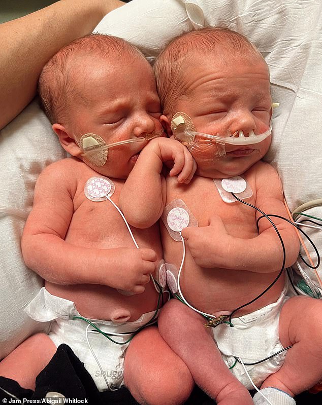 In August 2023, at only 34 weeks, the decision to deliver the twins via c-section was made