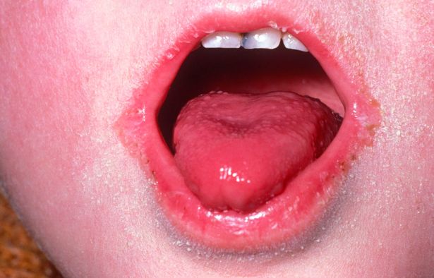 GPs can often diagnose scarlet fever by looking at your tongue and rash.